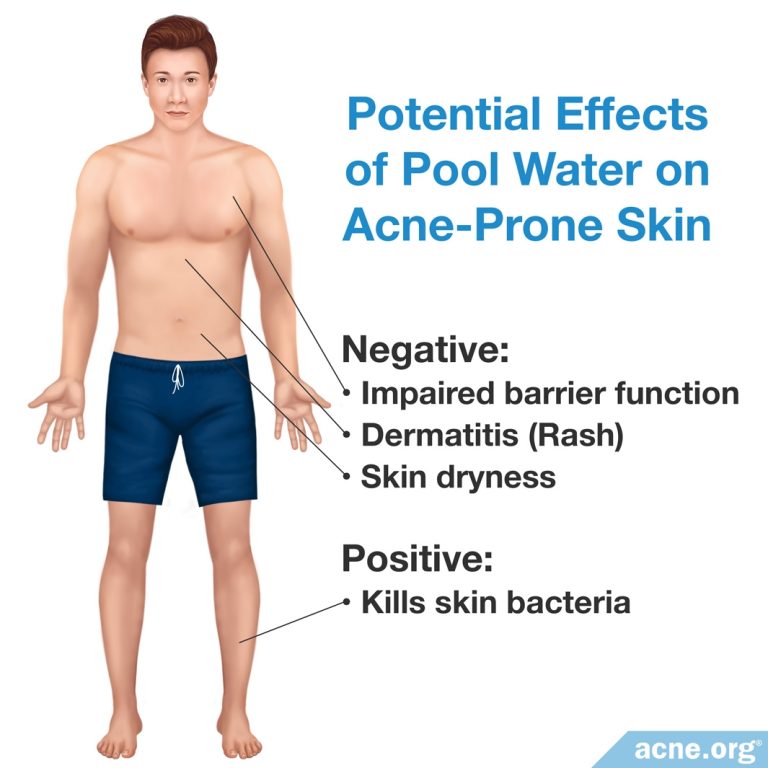 Can Chlorine Get Rid Of Acne?