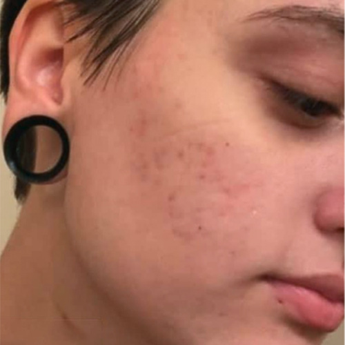 Does Panoxyl Work For Acne Scars?