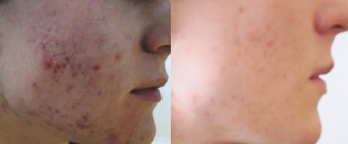 What Is Active Acne?