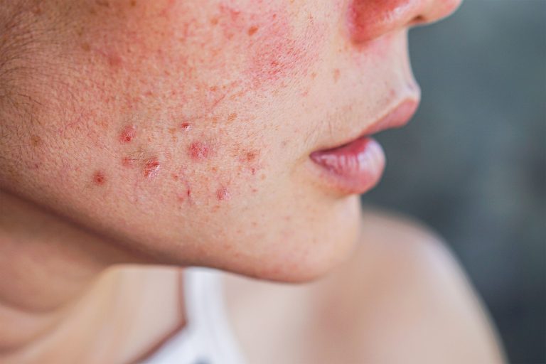 How To Prevent Acne From Adderall?