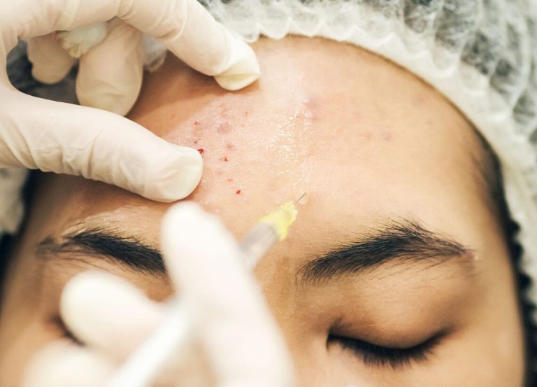 Can Botox Help Acne?