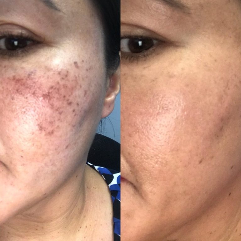 Is Microneedling Permanent For Acne Scars?