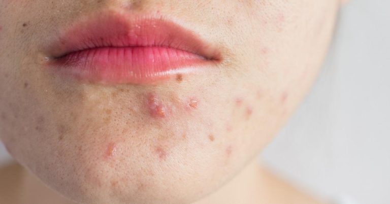 Does Vega Protein Cause Acne?