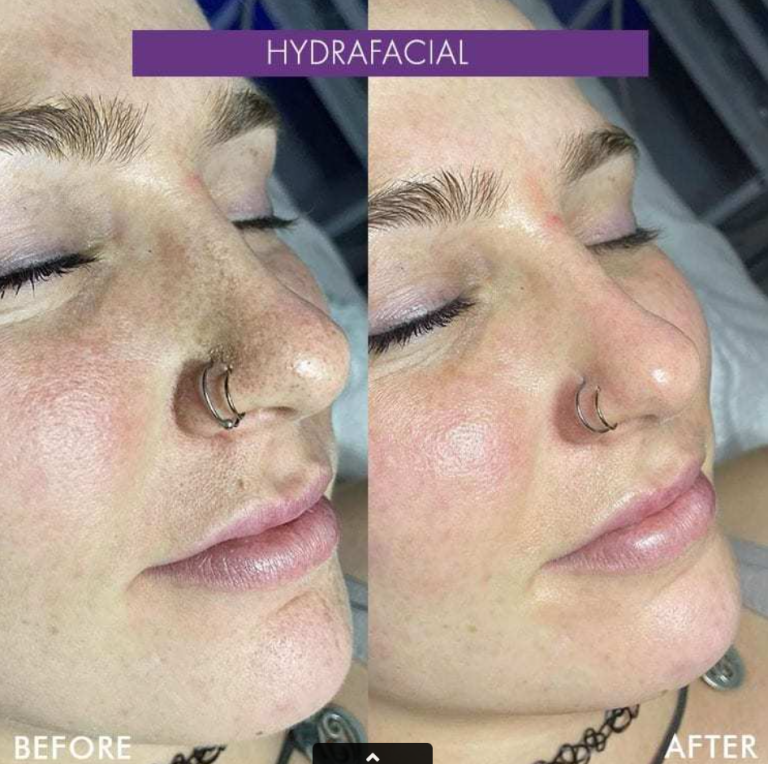 Is A Hydrafacial Good For Acne?