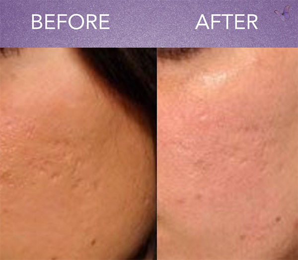 How Many Sessions Of Microneedling For Acne Scars?