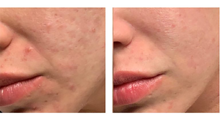 Is Morpheus8 Good For Acne Scars?