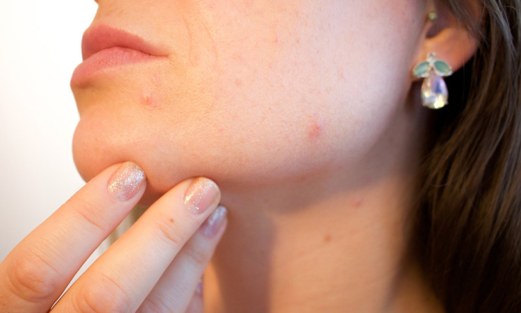 Can Tooth Infection Cause Cystic Acne?
